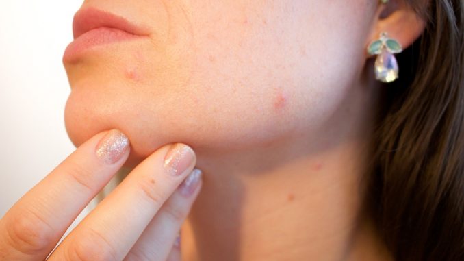 What are acne, its causes, symptoms, effects, and prevention methods